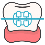Ceramic (discreet) braces