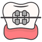Fixed (metal) braces