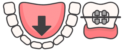 Lingual (hidden) braces