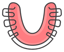 Fast braces